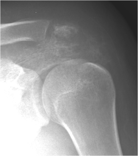 Ewings Tumour Acromion